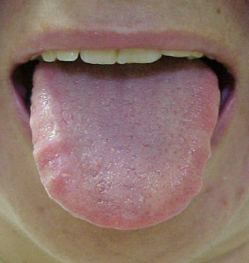 língua dentada