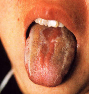 língua descamada