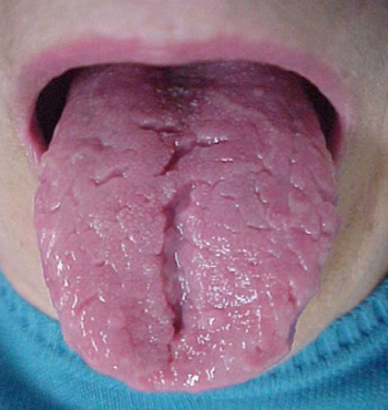 língua fissura