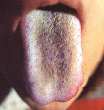língua roxa